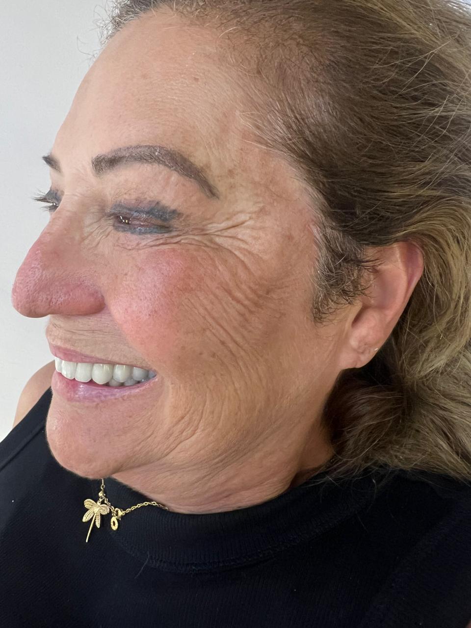 Bioestimulador de Colágeno