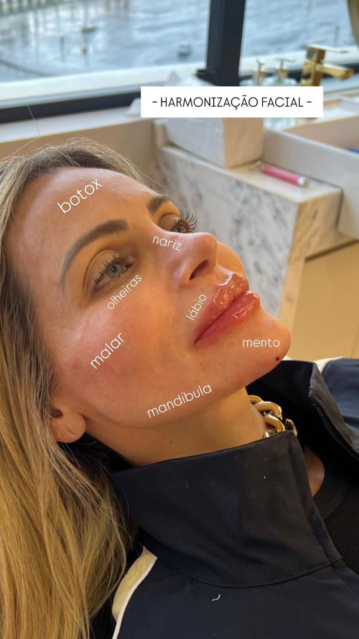 Harmonização Facial Completa